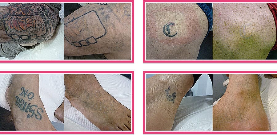 Eliminación tatuaje láser fotos antes y después
